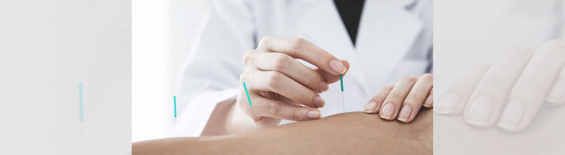 Dry Needling?