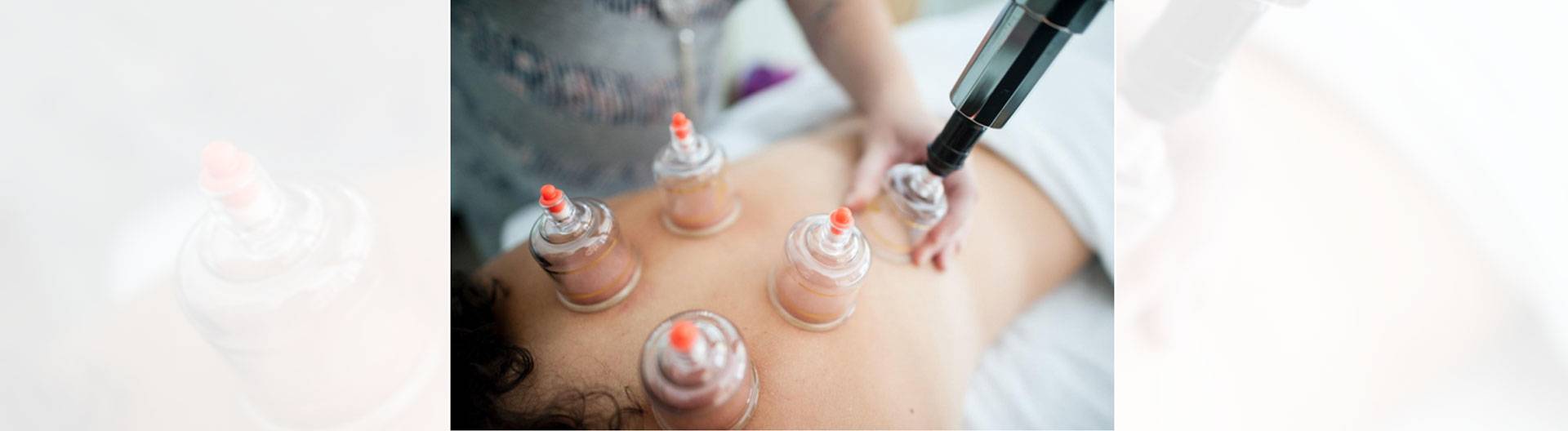 What Are The Benefits Of Cupping Therapy?