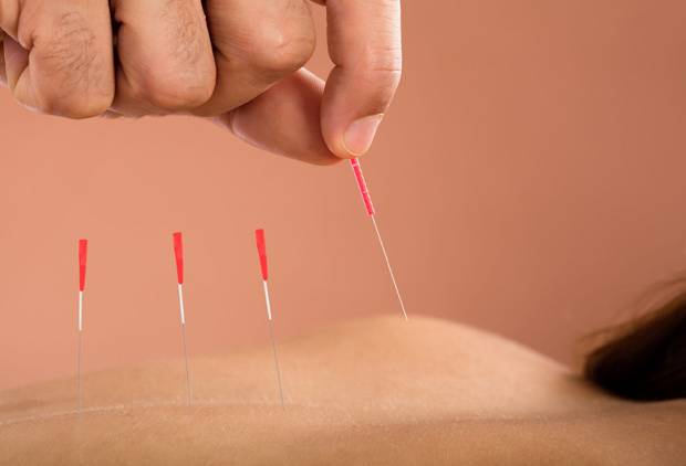 Dry Needling