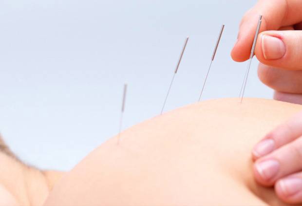 Dry Needling
