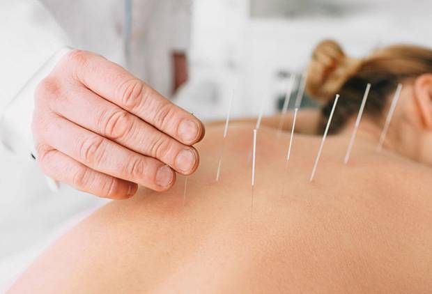 Dry Needling