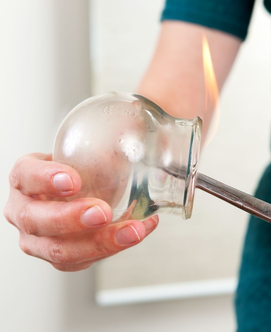 Therapist placing a glass cup during a cupping therapy session